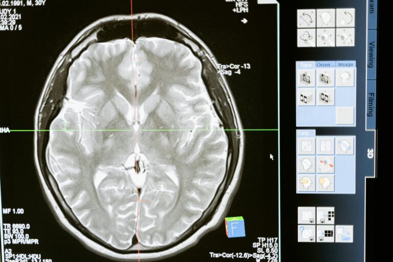 MRI brain scan comparison showing how an astronaut's brain changes position in zero gravity