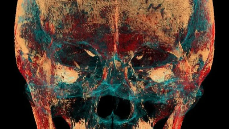 CT Scan Uncovers 2,500-Year-Old Jaw Surgery in Siberia