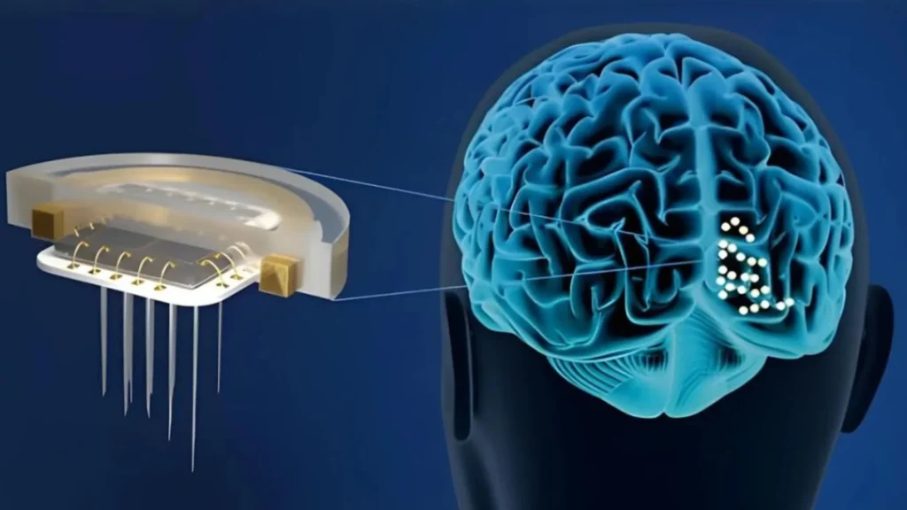 Wireless Brain Implant Restores Artificial Vision in Third Blindness Patient